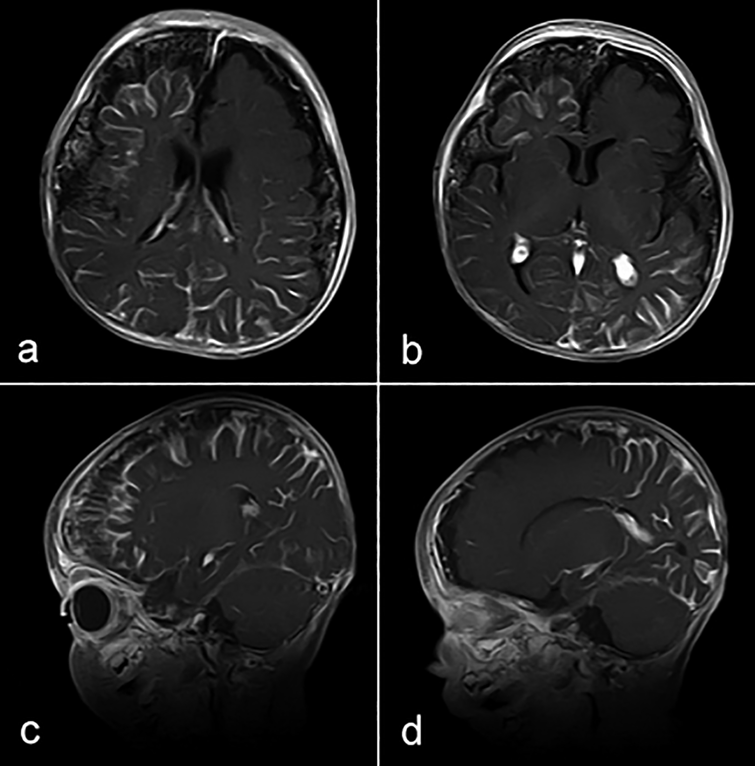 leptomeningeal angiomas