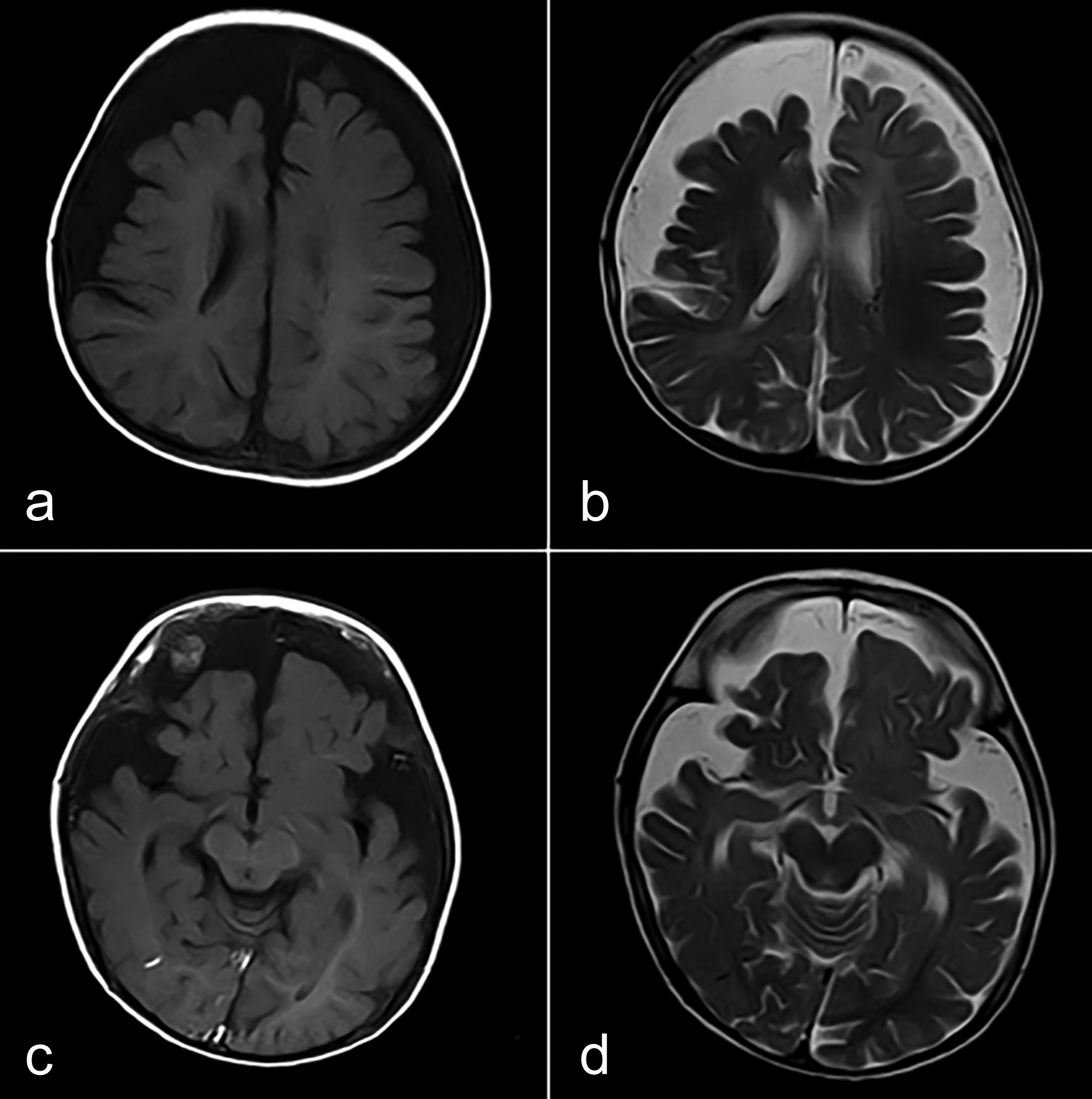 leptomeningeal angiomas