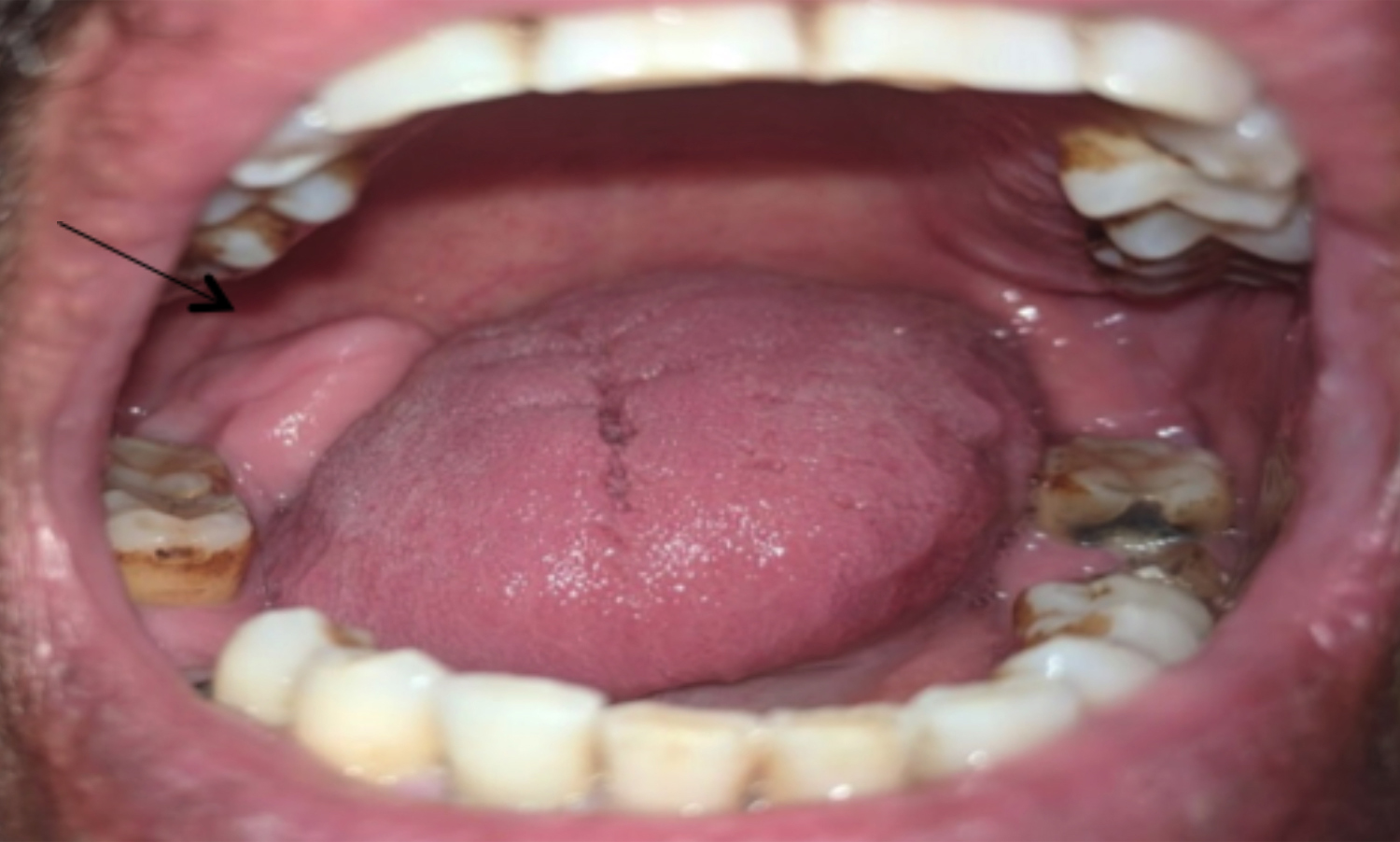 retromolar trigone swollen