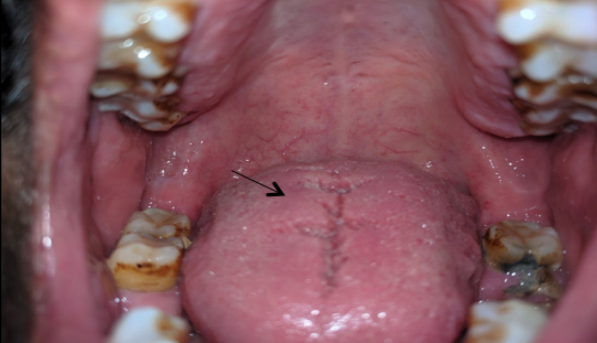 retromolar trigone swollen